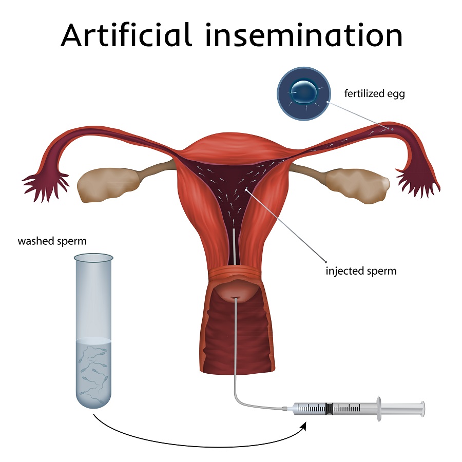 IUI intrauterine insemination