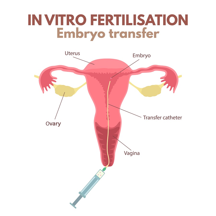 IVF Embryotransfer